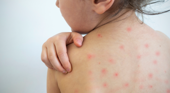 DGS alerta para caso importado de sarampo em Lisboa e Vale do Tejo