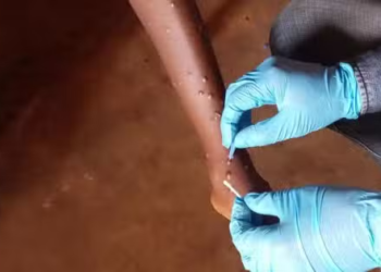 Monkeypox: OMS esclarece tudo o que precisa de saber